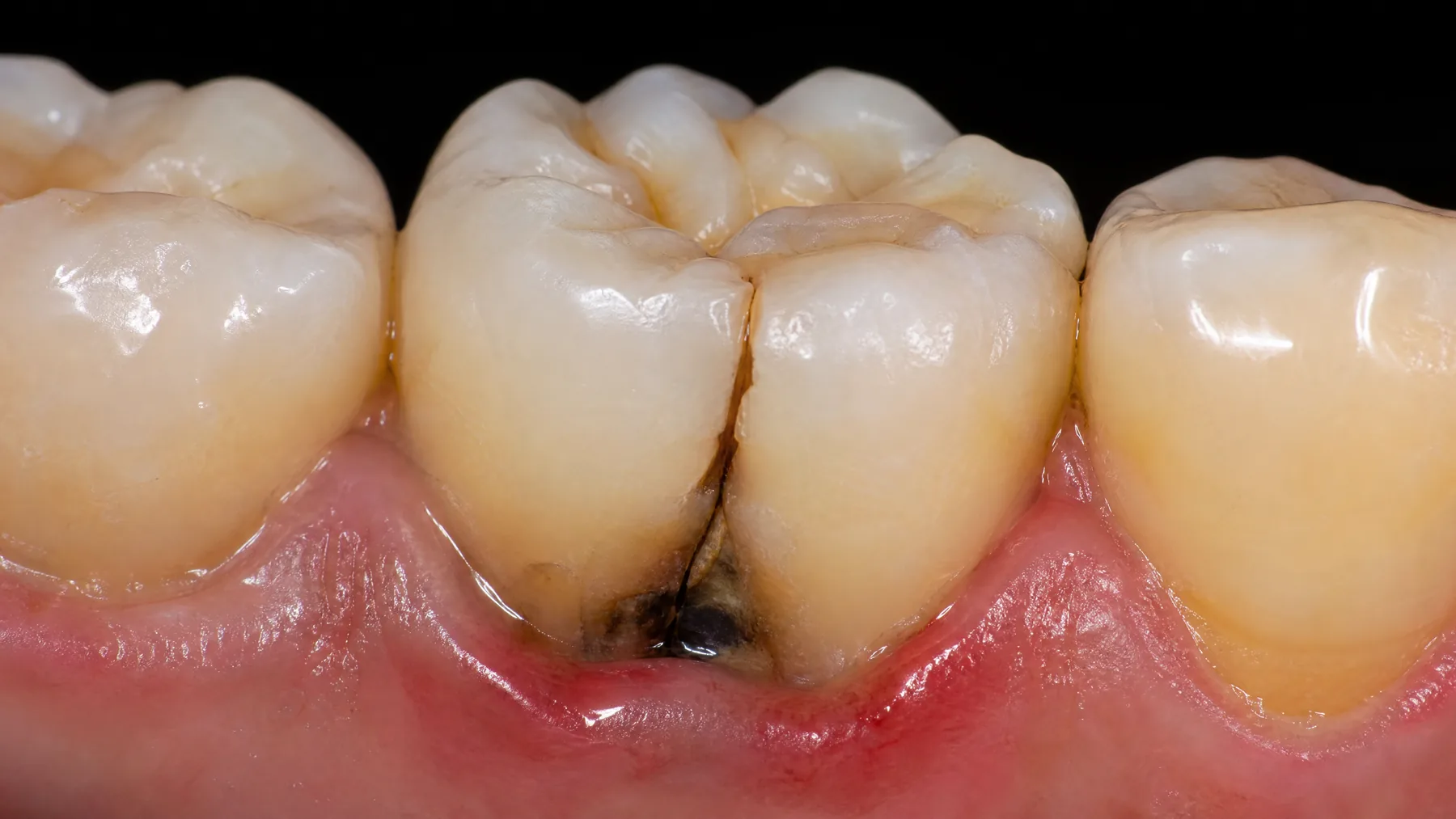 Root Canal Therapy in Scottsdale: Save Your Natural Tooth with Modern Endodontics